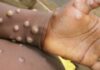 First US death from monkeypox confirmed by Los Angeles County